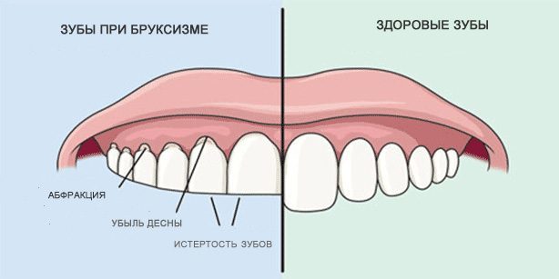 طحن الأسنان: الأسنان الصحية والأسنان خلال صريف الأسنان