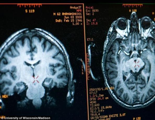 الدماغ ماتيو ريكارد صورة حصلت عليها MRI