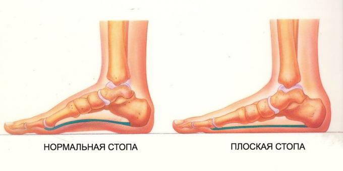 تمارين للأقدام مسطحة: قدم الطبيعي وشقة