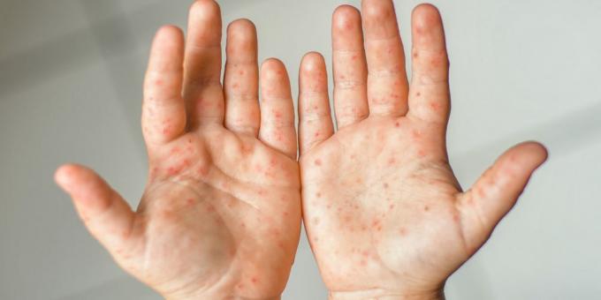 أعراض فيروس كوكساكي: طفح جلدي